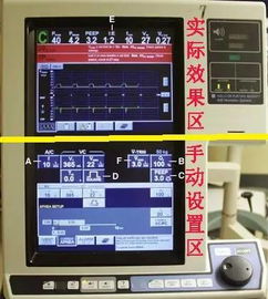 呼吸机菜鸟入门系列丨重要参数设置及a c模式