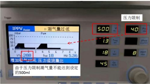 呼吸机5种模式不会选择？看完这篇你就懂了——ST模式详解